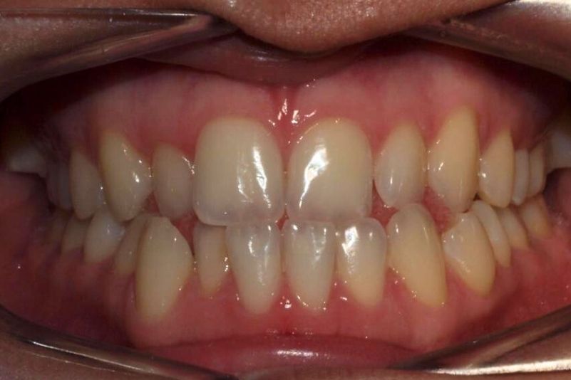 Antes camuflaje Ortodóncico Antes camuflaje Ortodóncico