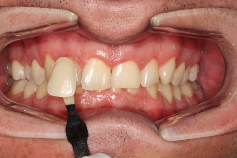 BLANQUEAMIENTO ANTES 5 (1) BLANQUEAMIENTO ANTES 5 (1)