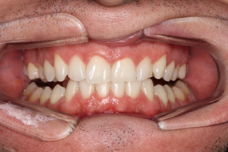 BLANQUEAMIENTO DESPUES 51 BLANQUEAMIENTO DESPUES 51