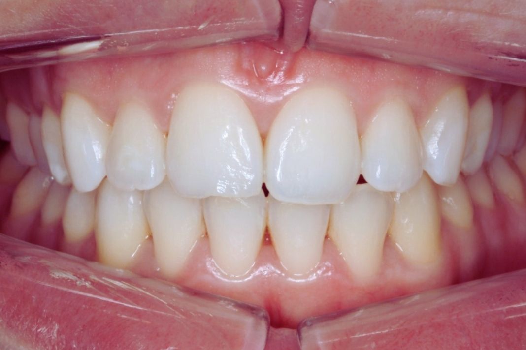 Después camuflaje Ortodóncico Después camuflaje Ortodóncico