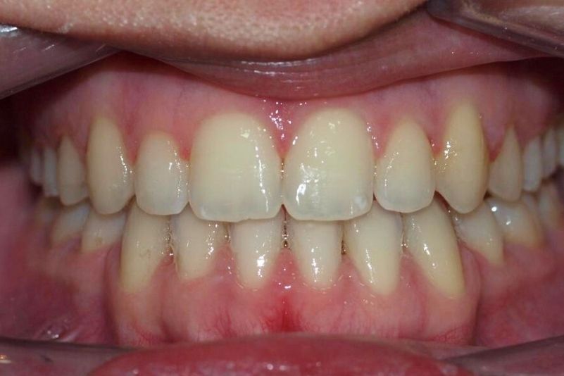 Después camuflaje Ortodóncico Después camuflaje Ortodóncico