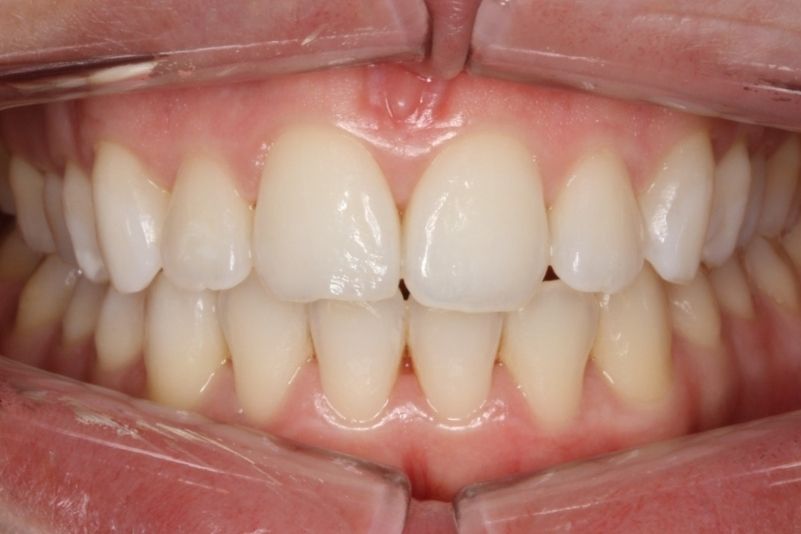 blanqueamient despues blanqueamient despues