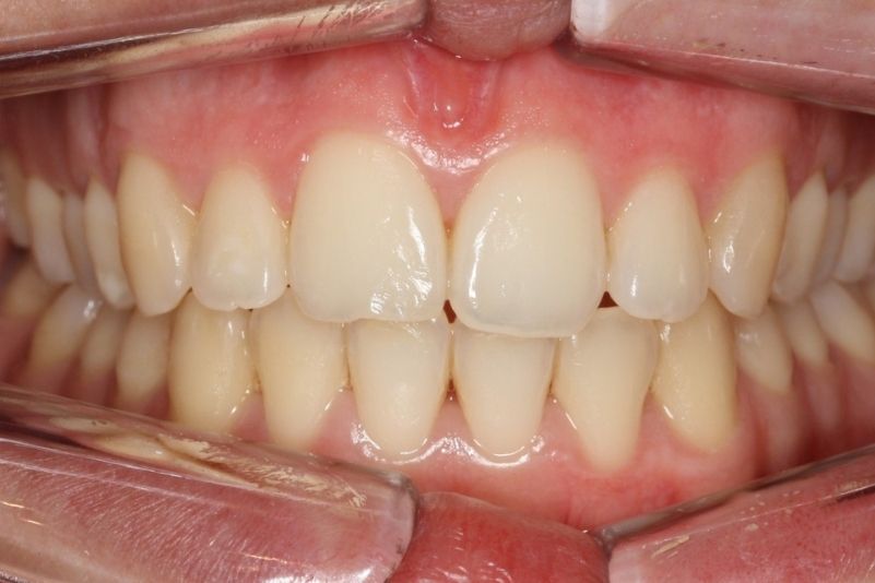 blanqueamiento dental antes blanqueamiento dental antes