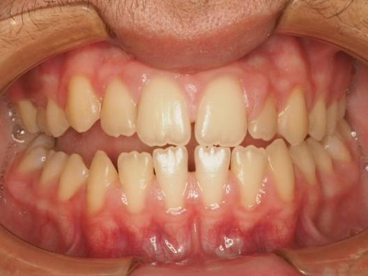 Ortodoncia en paciente adolescente antes Ortodoncia en paciente adolescente antes