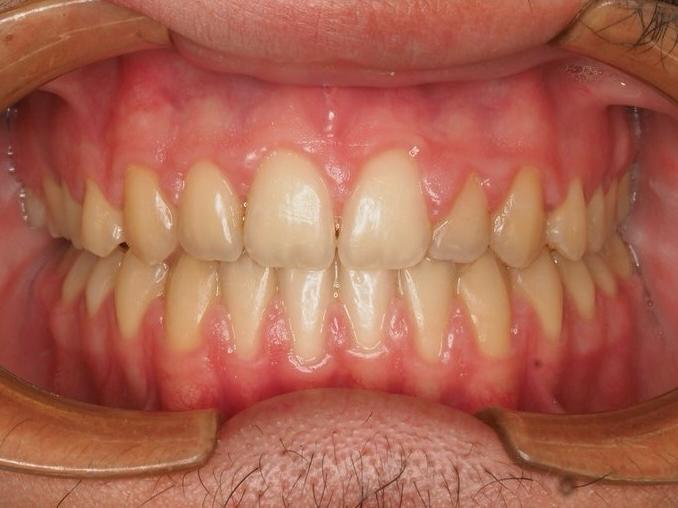 Ortodoncia en paciente adolescente despues Ortodoncia en paciente adolescente después